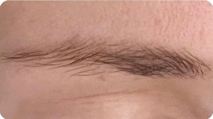 Удаление татуажа - результат процедур, фото 4