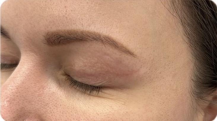 Удаление татуажа - результат процедур, фото 2