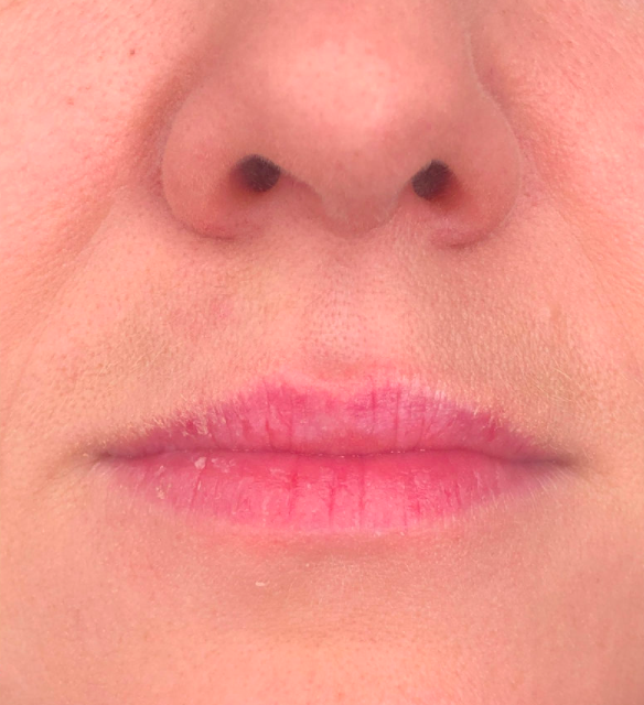 Лечение пигментации - результат процедур, фото 1