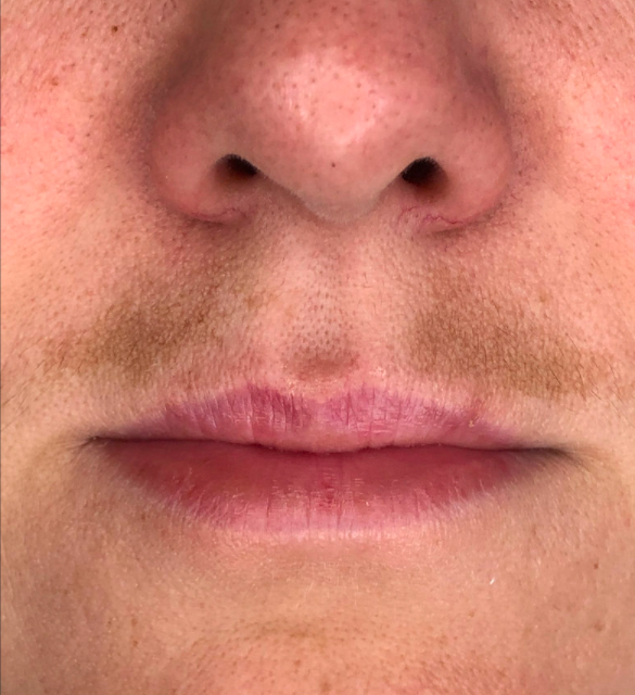 Лечение пигментации - результат процедур, фото 1