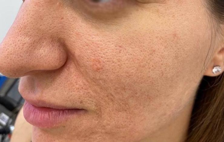 Лазерное омоложение - результат процедур, фото 2