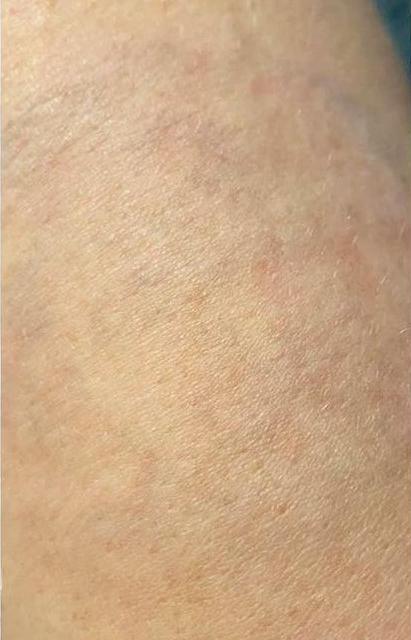 Удаление тату - результат процедур, фото 4