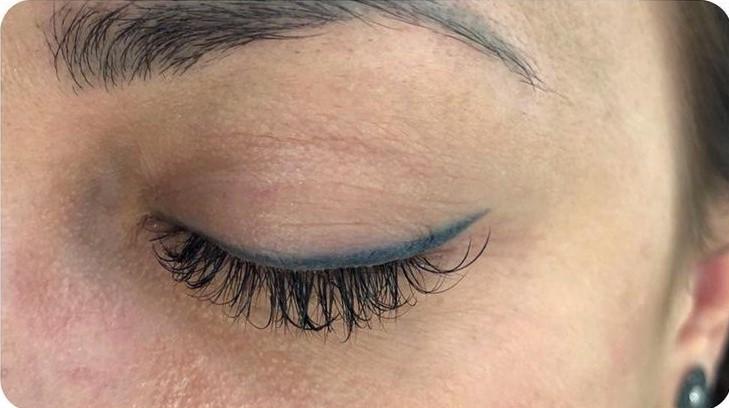 Удаление татуажа - результат процедур, фото 7