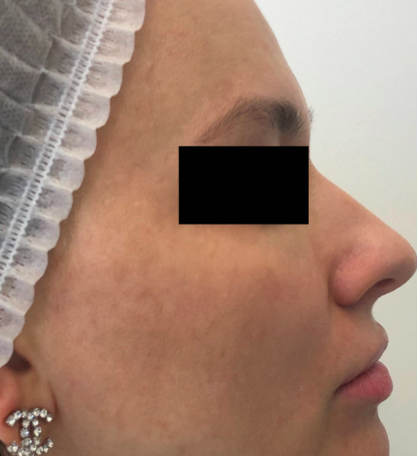 Лечение пигментация - результат процедур, фото 4