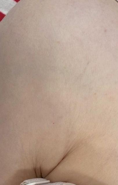 Удаление тату - результат процедур, фото 2