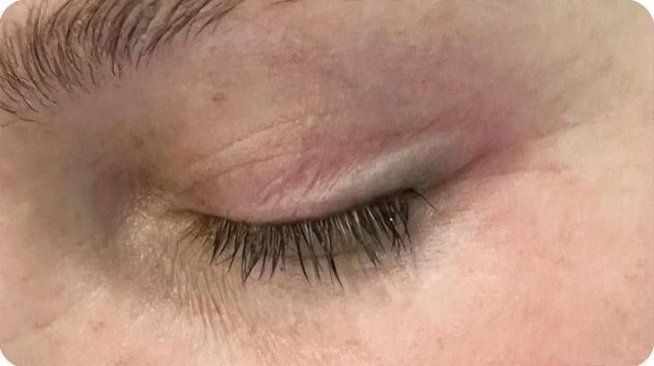 Удаление татуажа - результат процедур, фото 5