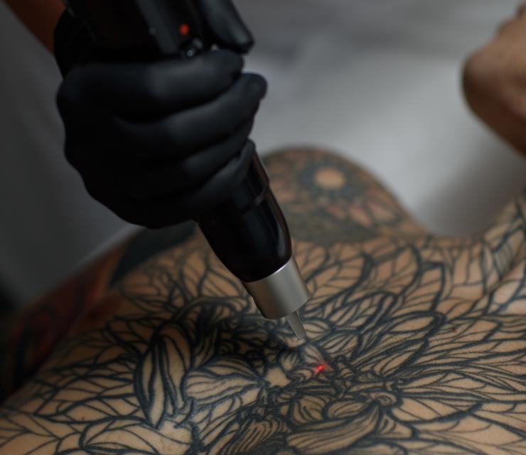 Удаление татуировок лазером в Москве - процедуры lartclinic.ru Удаление татуировок лазером в Москве - косметические процедуры, фото