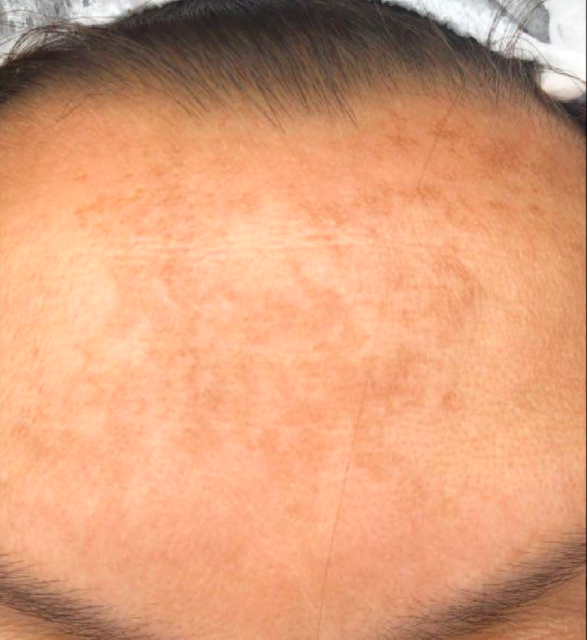 Лечение пигментация - результат процедур, фото 2