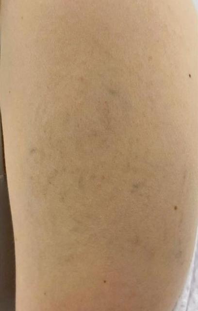 Удаление тату - результат процедур, фото 5