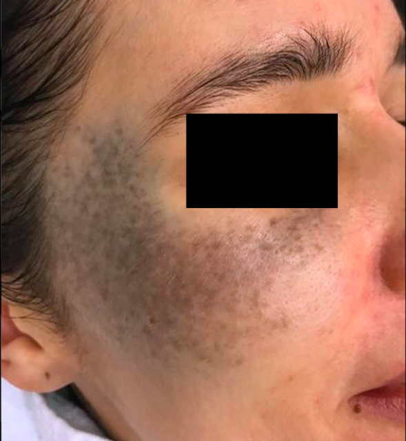 Лечение пигментация - результат процедур, фото 5