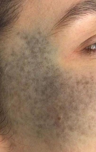 Невус Ота - результат процедур, фото 1