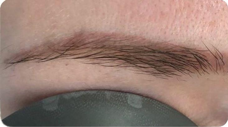 Удаление татуажа - результат процедур, фото 4