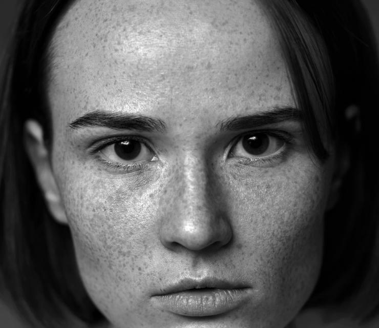 Удаление пигментных пятен лазером - процедуры lartclinic.ru Удаление пигментных пятен лазером - косметические процедуры, фото