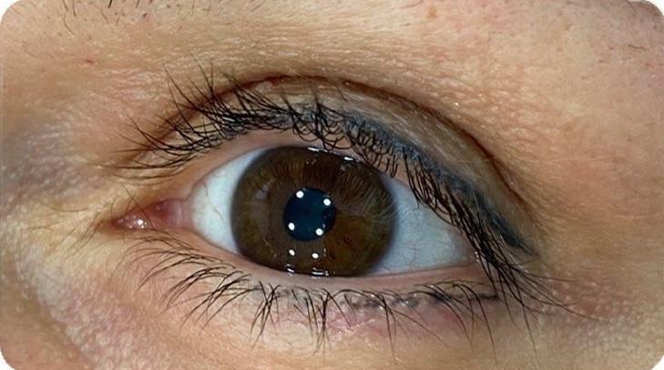 Удаление татуажа - результат процедур, фото 3