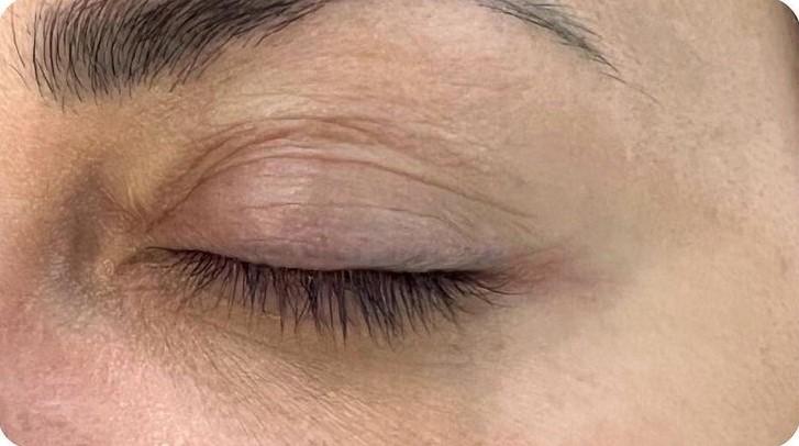 Удаление татуажа - результат процедур, фото 7