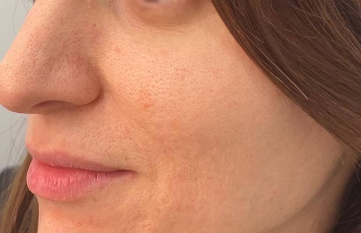 Лазерное омоложение - результат процедур, фото 2