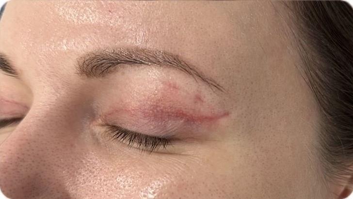 Удаление татуажа - результат процедур, фото 2