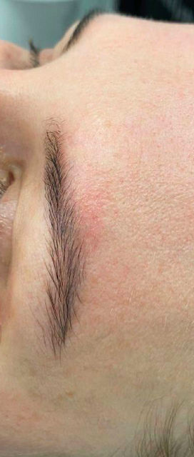 Удаление татуажа - результат процедур, фото 1