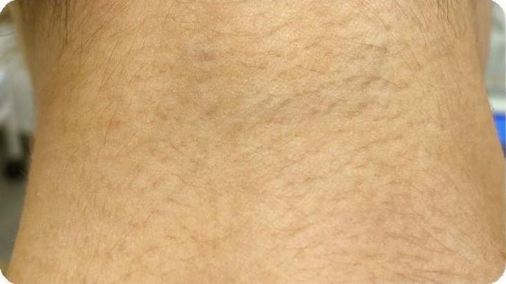 Удаление тату - результат процедур, фото 8