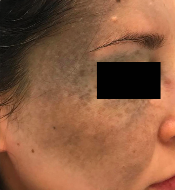 Лечение пигментация - результат процедур, фото 6