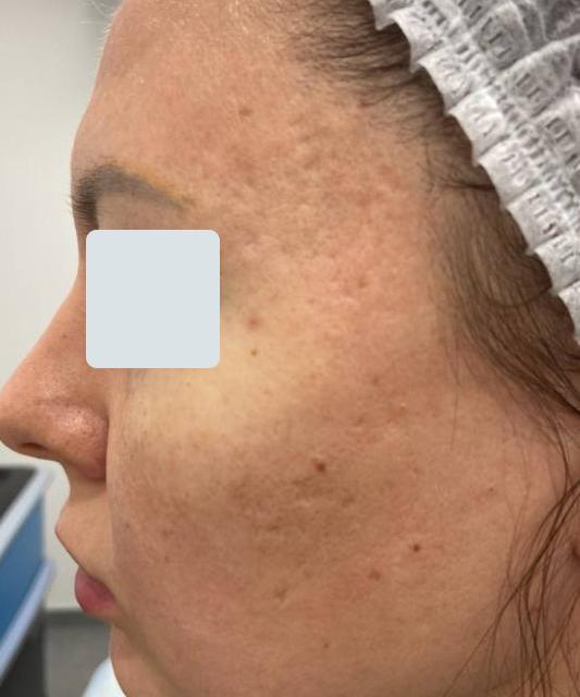 Лазерное омоложение - результат процедур, фото 1