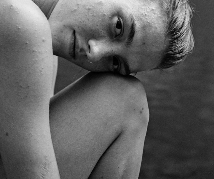 Лазерное лечение акне - процедуры lartclinic.ru Лазерное лечение акне - косметические процедуры, фото