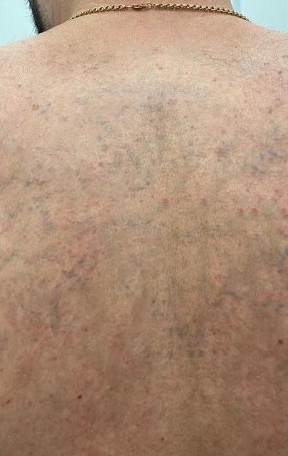 Удаление тату - результат процедур, фото 7