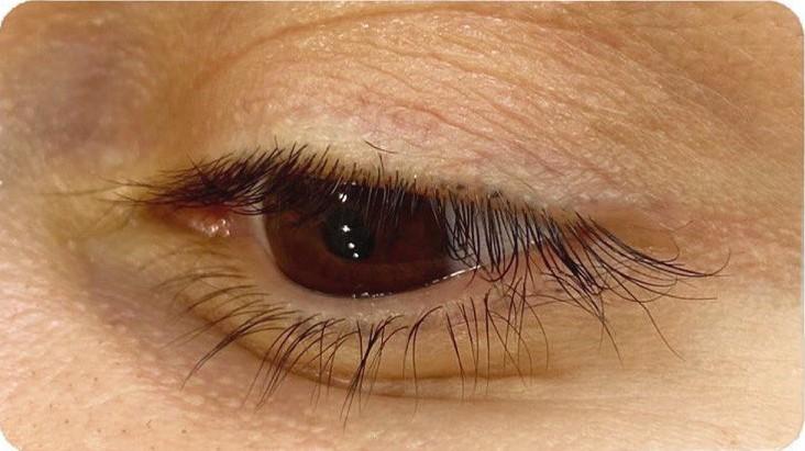 Удаление татуажа - результат процедур, фото 3