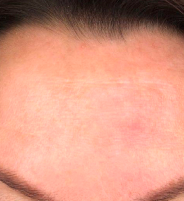 Лечение пигментация - результат процедур, фото 2