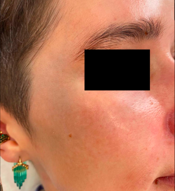 Лечение пигментация - результат процедур, фото 5