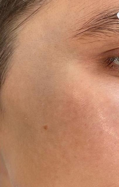 Невус Ота - результат процедур, фото 1