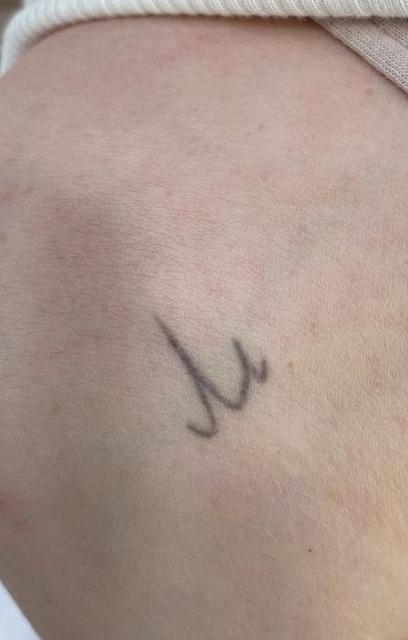 Удаление тату - результат процедур, фото 2