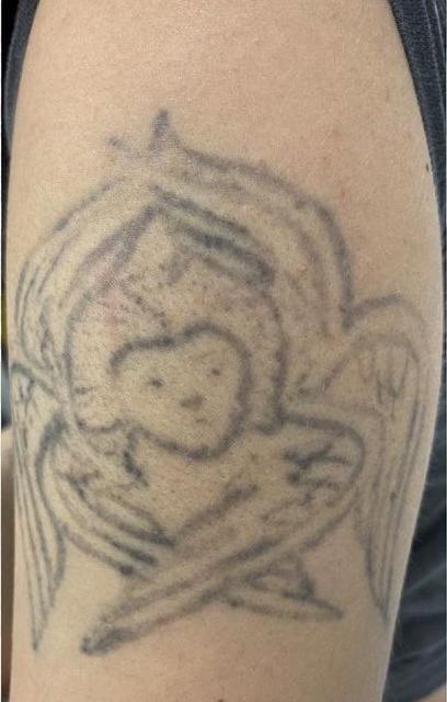 Удаление тату - результат процедур, фото 5