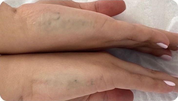 Удаление тату - результат процедур, фото 6