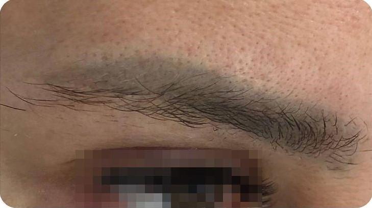 Удаление татуажа - результат процедур, фото 6