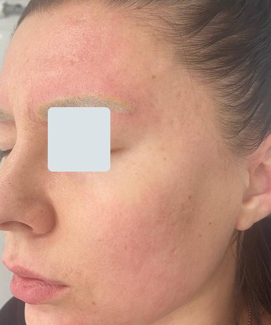 Лазерное омоложение - результат процедур, фото 1