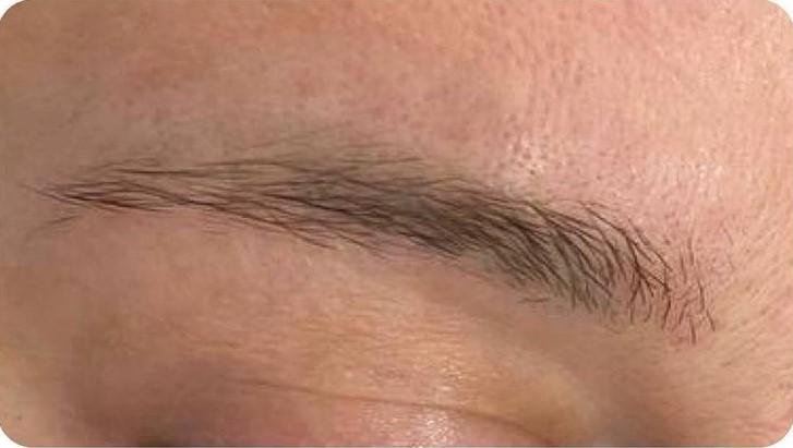 Удаление татуажа - результат процедур, фото 6