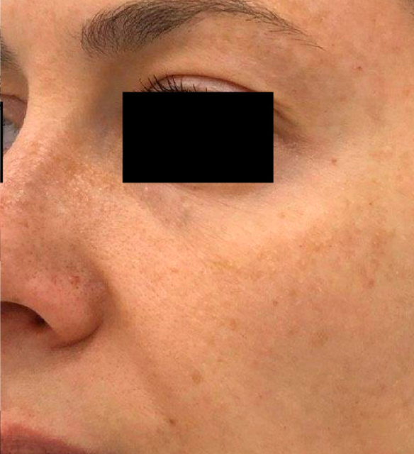 Лечение пигментация - результат процедур, фото 3