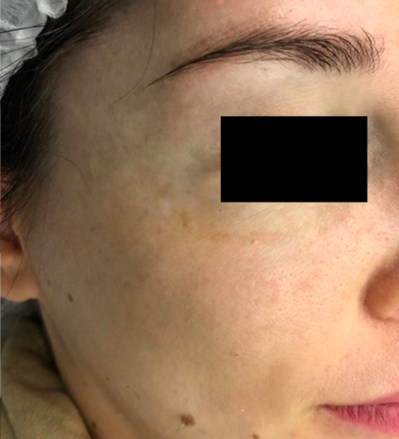 Лечение пигментация - результат процедур, фото 6