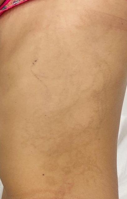 Удаление тату - результат процедур, фото 3