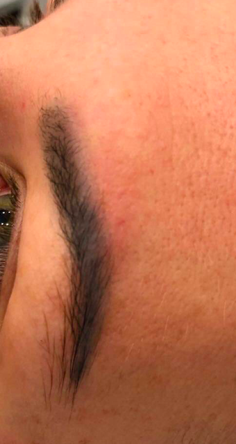 Удаление татуажа - результат процедур, фото 1