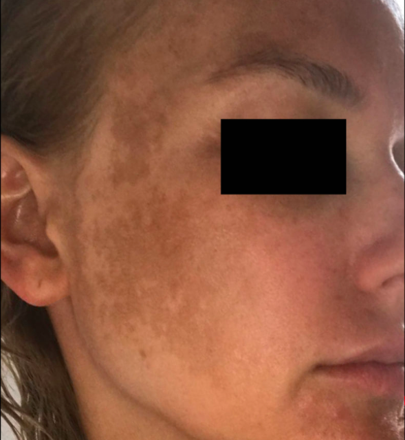 Лечение пигментация - результат процедур, фото 4