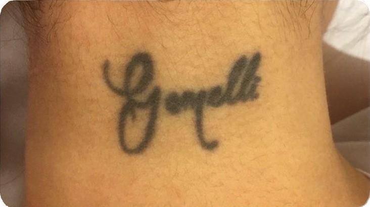 Удаление тату - результат процедур, фото 8