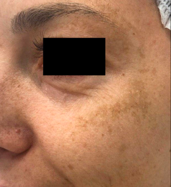 Лечение пигментация - результат процедур, фото 3